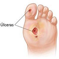El pie diabetico es un trastorno de los pies de los diabéticos provocado por la enfermedad de las arterias periféricas que irrigan el pie, complicado a menudo por daño de los nervios periféricos del pie e infección. Debido a la oclusión de las arterias que llevan sangre a los pies se produce gangrena.
El pie del paciente diabético es muy sensible a todas formas de traumatismos: el talón y las prominencias óseas resultan especialmente vulnerables.
Los daños a los nervios periféricos de los pies provocan trastornos sensoriales, úlceras de la planta del pie, atrofia de la piel.
Es frecuente en los pacientes diabéticos que las lesiones propias del denominado pie diabético trascurran sin dolor, debido a lo cual se suele agravar la lesión antes de que el paciente pida ayuda especializada.
En estos casos se realizara un seguimiento y unas pautas de actuación para la prevención de lesiones.
En los casos en los que el paciente ya presente algún tipo de lesión o ulceración se enfocaran las curas en relación al tipo de ulceración presente valorando la aplicación de manera coadyuvante de un tratamiento ortésico para un mejor tratamiento de la lesión.